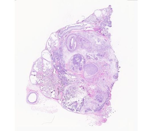 Los teratomas (tumores monstruosos) serían modelo del desarrollo humano Imagen de histología de un teratoma