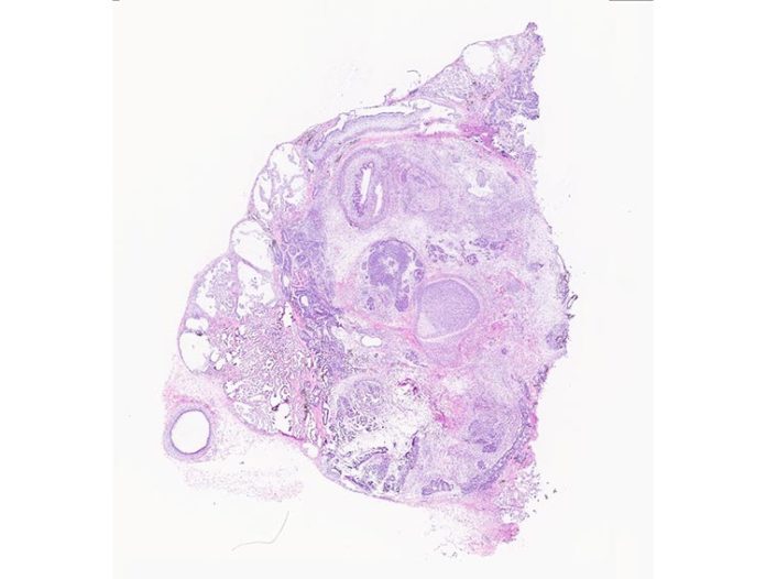 Imagen de histología de un teratoma