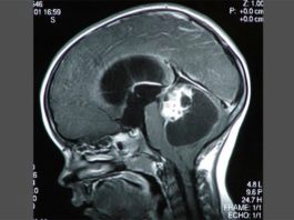 Cáncer: Investigadores descubren cómo el ácido láctico debilita las defensas antitumorales Tumores cerebrales pediátricos