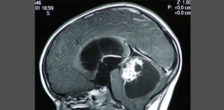 Cáncer: Investigadores descubren cómo el ácido láctico debilita las defensas antitumorales Tumores cerebrales pediátricos