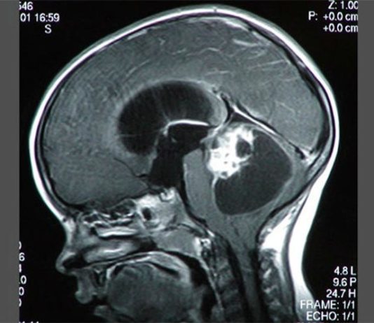 Cáncer: Investigadores descubren cómo el ácido láctico debilita las defensas antitumorales Tumores cerebrales pediátricos