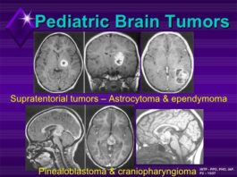 Tumores cerebrales pediátricos: Estudio proteogenómico a gran escala Tumores cerebrales pediátricos