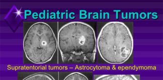 Tumores cerebrales pediátricos: Estudio proteogenómico a gran escala Tumores cerebrales pediátricos