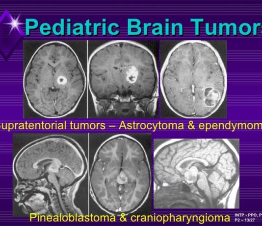Tumores cerebrales pediátricos: Estudio proteogenómico a gran escala Tumores cerebrales pediátricos