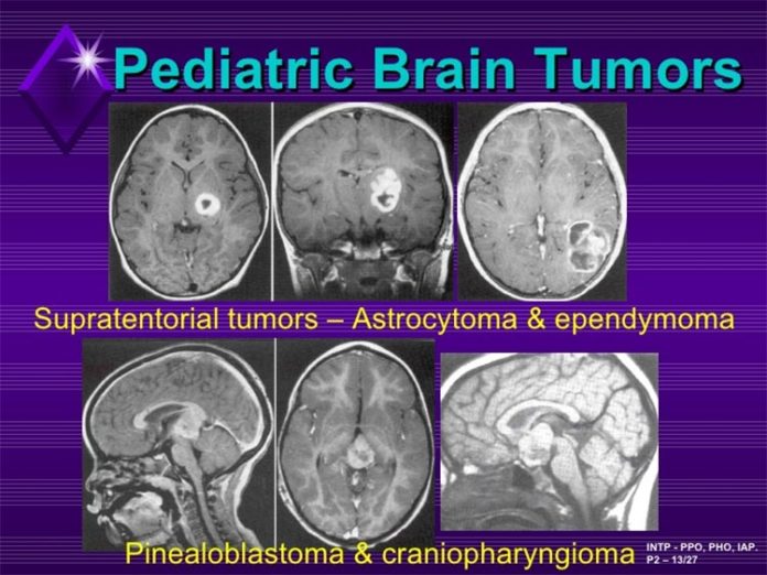 Tumores cerebrales pediátricos