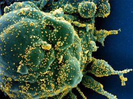 Determinan con precisión cómo el virus SARS-CoV-2 daña rápidamente a las células pulmonares Micrografía electrónica de barrido coloreada de una célula apoptótica (verde) muy infectada con partículas del virus SARS-COV-2 (amarillo)