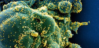 Determinan con precisión cómo el virus SARS-CoV-2 daña rápidamente a las células pulmonares Micrografía electrónica de barrido coloreada de una célula apoptótica (verde) muy infectada con partículas del virus SARS-COV-2 (amarillo)