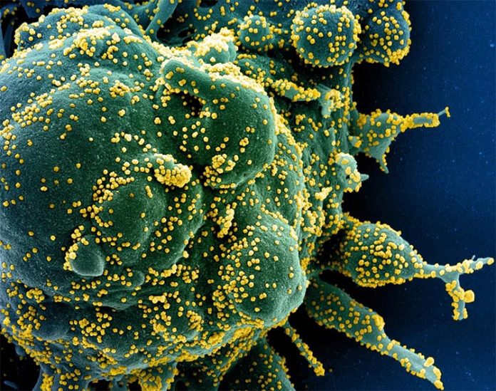 Micrografía electrónica de barrido coloreada de una célula apoptótica (verde) muy infectada con partículas del virus SARS-COV-2 (amarillo)