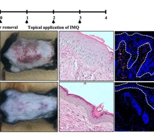 Psoriasis y el sistema inmune: una nueva investigación podría conducir a una terapia Investigación sobre la psoriasis en ratones
