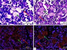 Usan membranas de glóbulos blancos humanos para transportar medicamentos Micrografía de tejido pulmonar infectado por P. aeruginosa