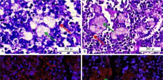 Usan membranas de glóbulos blancos humanos para transportar medicamentos Micrografía de tejido pulmonar infectado por P. aeruginosa