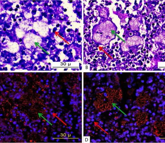 Usan membranas de glóbulos blancos humanos para transportar medicamentos Micrografía de tejido pulmonar infectado por P. aeruginosa