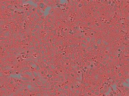 Un nuevo estudio revela una vulnerabilidad de las células cancerosas: la aneuploidía Células cancerosas