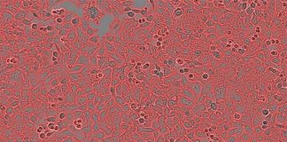 Un nuevo estudio revela una vulnerabilidad de las células cancerosas: la aneuploidía Células cancerosas