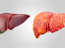La terapia mRNA-LNP logra regenerar el hígado Hígado sano (izquierda) e hígado graso.