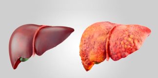 La terapia mRNA-LNP logra regenerar el hígado Hígado sano (izquierda) e hígado graso.