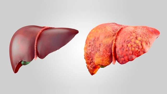 Hígado sano (izquierda) e hígado graso.