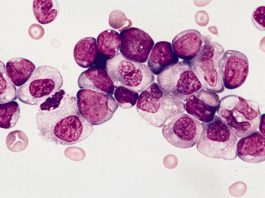 Poderosa terapia prometedora para la leucemia mieloide aguda (LMA) Leucemia mieloide aguda con maduración granulocítica