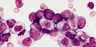 Poderosa terapia prometedora para la leucemia mieloide aguda (LMA) Leucemia mieloide aguda con maduración granulocítica