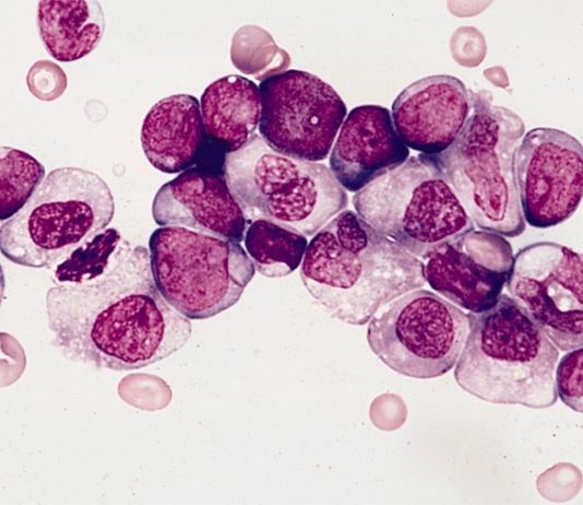 Poderosa terapia prometedora para la leucemia mieloide aguda (LMA) Leucemia mieloide aguda con maduración granulocítica