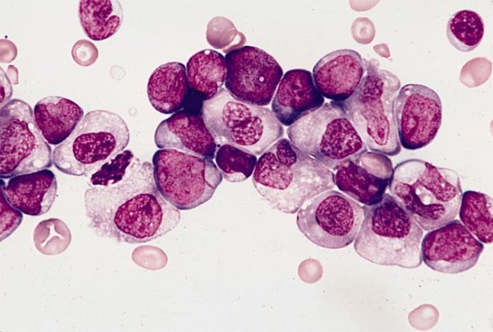 Leucemia mieloide aguda con maduración granulocítica