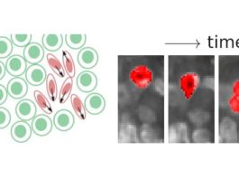 Cáncer: Las células cancerosas se fluidizan y se aprietan a través del tejido Los investigadores encontraron regiones líquidas y sólidas en tumores de mama y cuello uterino. Las regiones fluidas pueden ser reconocidas por células cancerosas alargadas que se aprietan a través del denso tejido tumoral