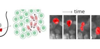 Cáncer: Las células cancerosas se fluidizan y se aprietan a través del tejido Los investigadores encontraron regiones líquidas y sólidas en tumores de mama y cuello uterino. Las regiones fluidas pueden ser reconocidas por células cancerosas alargadas que se aprietan a través del denso tejido tumoral