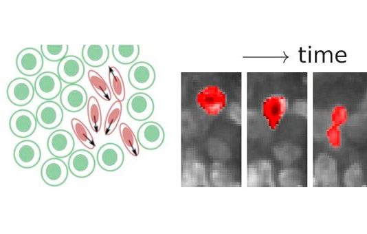 Cáncer: Las células cancerosas se fluidizan y se aprietan a través del tejido Los investigadores encontraron regiones líquidas y sólidas en tumores de mama y cuello uterino. Las regiones fluidas pueden ser reconocidas por células cancerosas alargadas que se aprietan a través del denso tejido tumoral