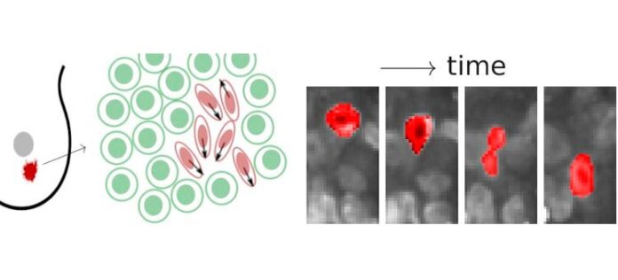 Los investigadores encontraron regiones líquidas y sólidas en tumores de mama y cuello uterino. Las regiones fluidas pueden ser reconocidas por células cancerosas alargadas que se aprietan a través del denso tejido tumoral Los investigadores encontraron regiones líquidas y sólidas en tumores de mama y cuello uterino. Las regiones fluidas pueden ser reconocidas por células cancerosas alargadas que se aprietan a través del denso tejido tumoral