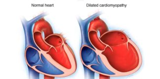 Las células madre revelan las causas de una forma congénita de miocardiopatía dilatada Miocardiopatía dilatada