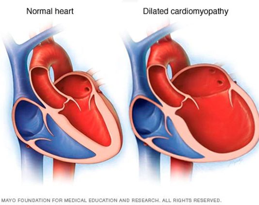Las células madre revelan las causas de una forma congénita de miocardiopatía dilatada Miocardiopatía dilatada