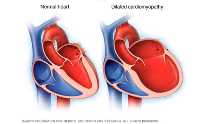 Miocardiopatía dilatada