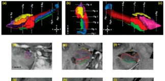 Estudio pionero relaciona los traumas infantiles con cambios cerebrales, depresión en la adultez y estrés Resonancia magnética (IRM) de alta resolución de los subcampos del hipocampo y los subnúcleos de la amígdala para analizar los efectos de traumas como el maltrato infantil