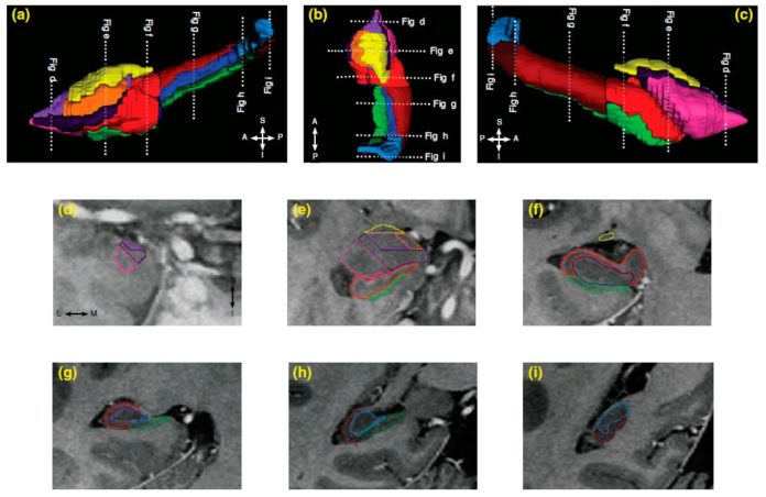 Resonancia magnética (IRM) de alta resolución de los subcampos del hipocampo y los subnúcleos de la amígdala para analizar los efectos de traumas como el maltrato infantil