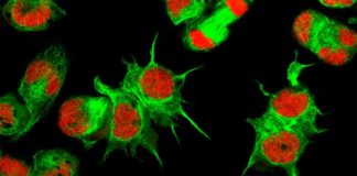 Nueva forma de atacar un cáncer infantil agresivo, el neuroblastoma Neuroblastoma