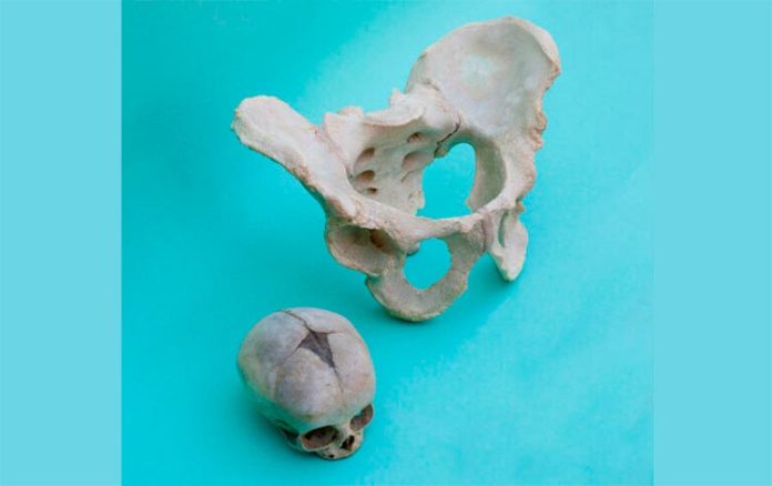 Fotografía de una pelvis humana femenina y el cráneo de un bebé recién nacido