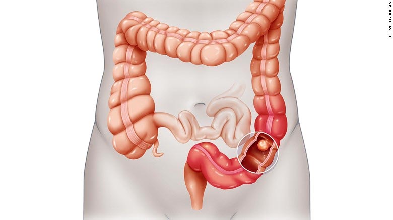 Cáncer de intestino (colorrectal)