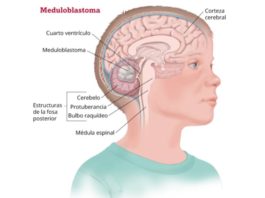 Descubren nueva forma de matar a las células cancerosas en el meduloblastoma Meduloblastoma