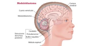 Descubren nueva forma de matar a las células cancerosas en el meduloblastoma Meduloblastoma