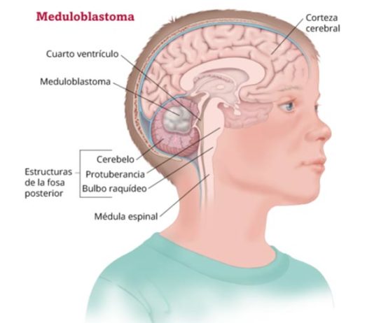 Descubren nueva forma de matar a las células cancerosas en el meduloblastoma Meduloblastoma