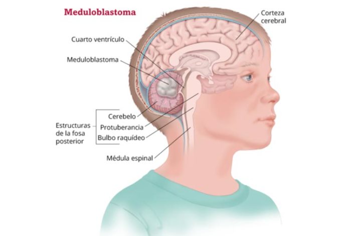 Meduloblastoma