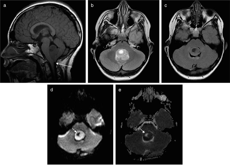 Meduloblastoma pediátrico