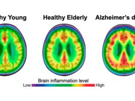La inflamación del tejido cerebral es clave para la progresión del Alzheimer Tanto las personas jóvenes como las de edad avanzada tienen un menor grado de neuroinflamación (rojo) que los pacientes con enfermedad de Alzheimer