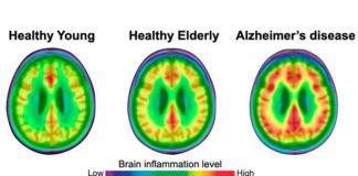 La inflamación del tejido cerebral es clave para la progresión del Alzheimer Tanto las personas jóvenes como las de edad avanzada tienen un menor grado de neuroinflamación (rojo) que los pacientes con enfermedad de Alzheimer