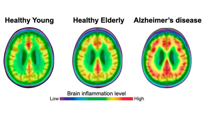 Tanto las personas jóvenes como las de edad avanzada tienen un menor grado de neuroinflamación (rojo) que los pacientes con enfermedad de Alzheimer Tanto las personas jóvenes como las de edad avanzada tienen un menor grado de neuroinflamación (rojo) que los pacientes con enfermedad de Alzheimer