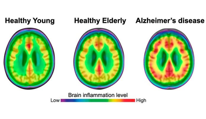 Tanto las personas jóvenes como las de edad avanzada tienen un menor grado de neuroinflamación (rojo) que los pacientes con enfermedad de Alzheimer