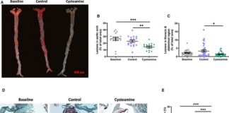 Un antioxidante revierte la arterioesclerosis en ratones y probablemente en humanos La cisteamina redujo la arterioesclerosis existente en ratones deficientes en receptores de lipoproteínas de baja densidad