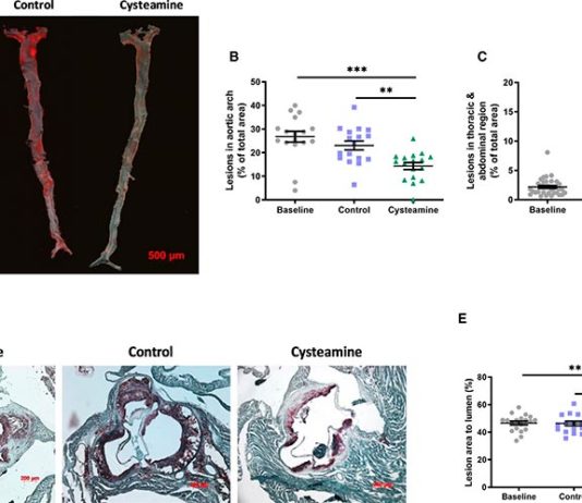 Un antioxidante revierte la arterioesclerosis en ratones y probablemente en humanos La cisteamina redujo la arterioesclerosis existente en ratones deficientes en receptores de lipoproteínas de baja densidad