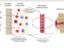 El intestino podría ser clave para aliviar la artritis reumatoide El intestino podría ser clave para aliviar la artritis reumatoide