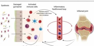 El intestino podría ser clave para aliviar la artritis reumatoide El intestino podría ser clave para aliviar la artritis reumatoide